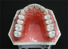 保定装置｜鷺ノ宮駅南口歯科